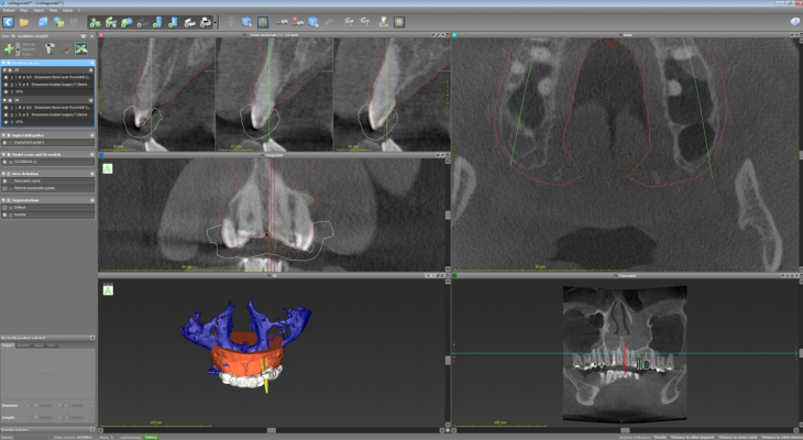 3D Surgical Guides